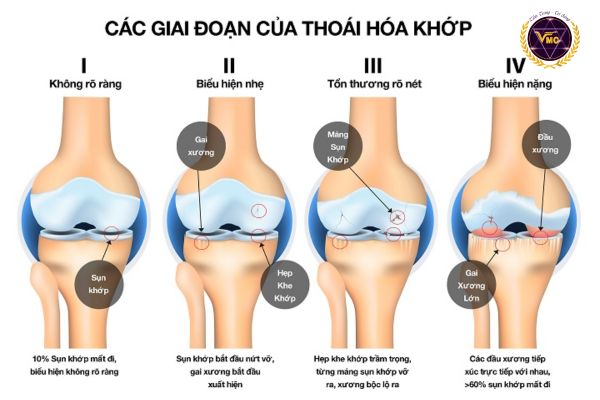 Hình ảnh các giai đoạn của thoái hóa khớp